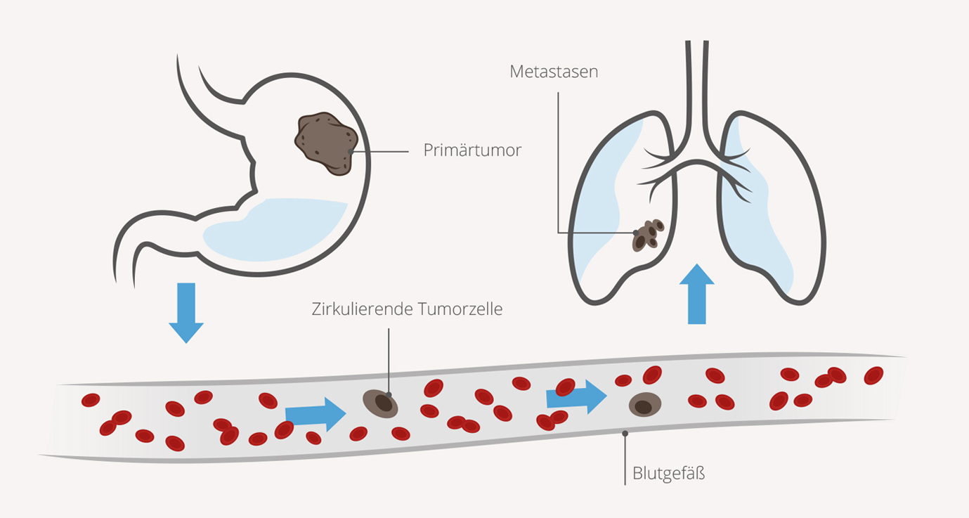 Erklärgrafik zu zirkulierenden Tumorzellen, Metastasen, Primärtumor, Blutgefäß