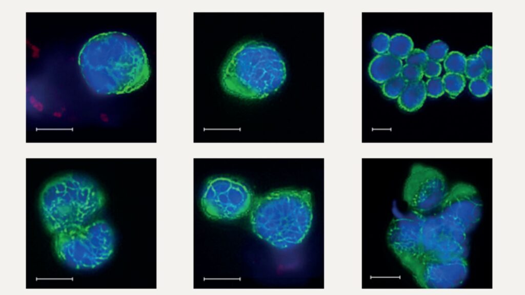 Ausgewählte CTCs eines Patienten mit Bauchspeicheldrüsenkrebs gefärbt mit fl uoreszenzmarkiertenAntikörpern gegen EpCAM/Keratine (grün), CD45 (rot) und Kernfärbung (blau). Epitheliale Tumorzellen sind positiv für EpCAM und/oder Keratine und negativ für CD45. Der Maßstabsbalken entspricht 10 µm